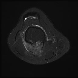 Parosteal Osteosarcoma MRI0001
